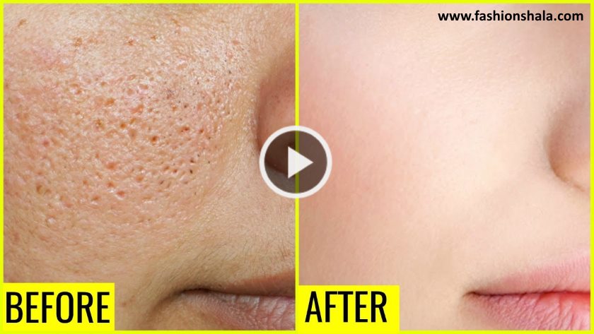 How to Get Rid of Large OPEN PORES Permanently